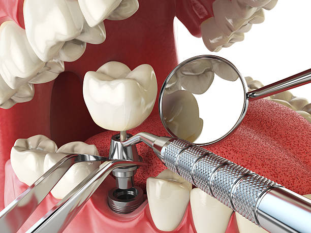 Best Emergency Tooth Extraction in Plymouth, MN